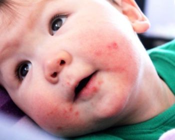 Проявление вируса Коксаки и эффективные способы борьбы