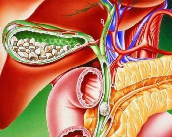 Лечение желчнокаменной болезни без оперативного вмешательства