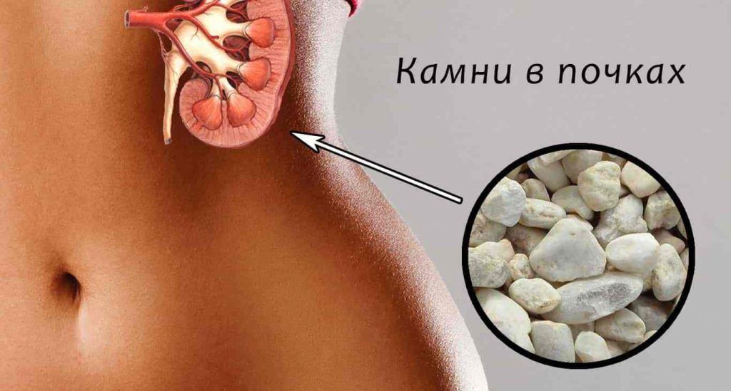Мочекаменная болезнь