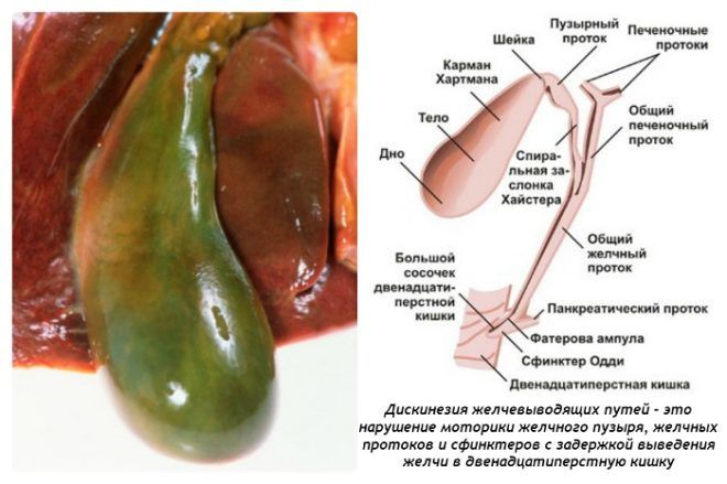 Холецистит хорошо поддается лечению расторопшей