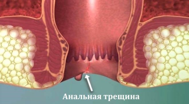 Изображение анальной трещины
