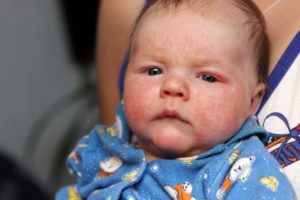 Аллергическое высыпание является побочным эффектом на вакцинацию