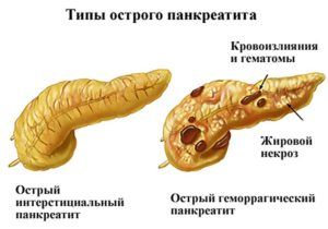 Острая форма панкреатита