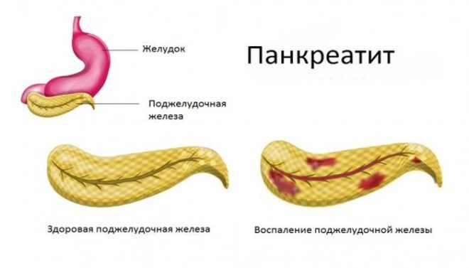 Горечь во рту возникает при панкреатите