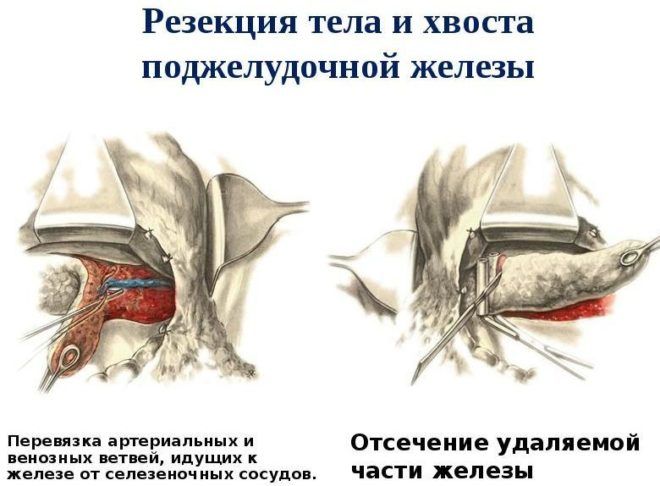 Резекция поджелудочной железы