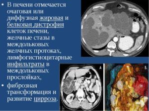 Кардинальный фиброз