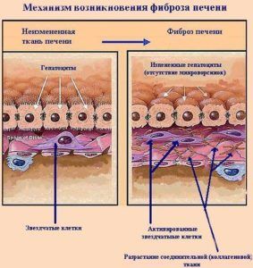 Классификация врожденного фиброза