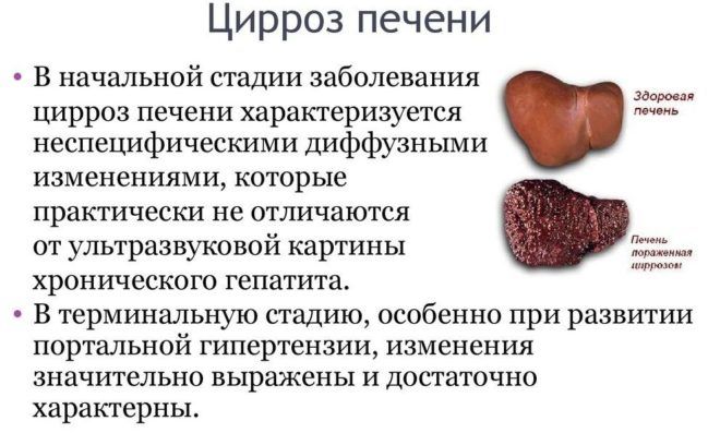 Последняя стадия фиброза является началом развития цирроза