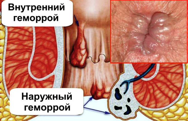Виды геморроидальных узлов при которых назначается мазь Релиф
