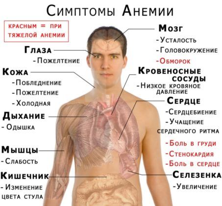Анемия