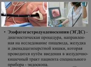 ЭГДС желудка