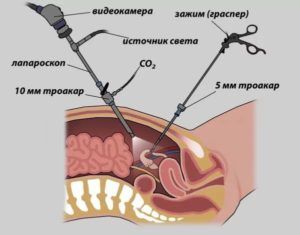 Лапароскопия при раке прямой кишки 