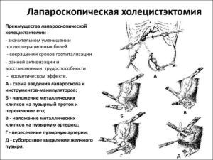 Лапароскопической холецистэктомии